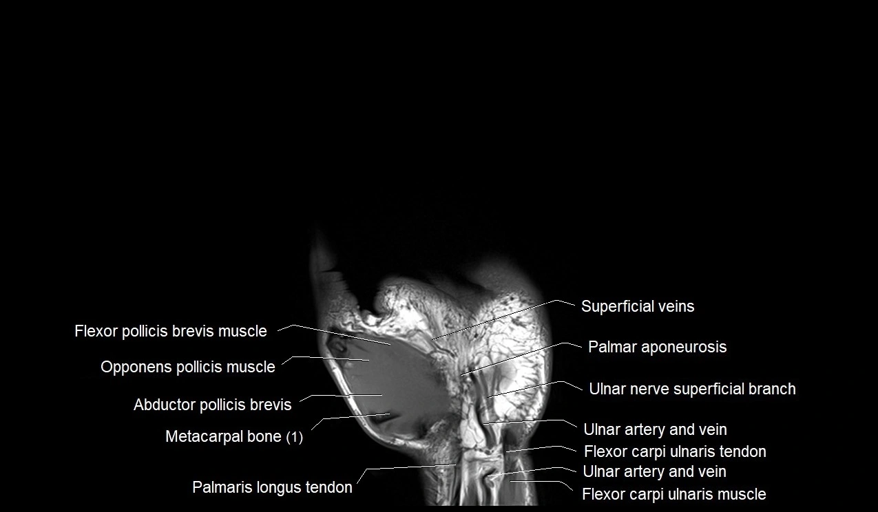 MRI 3T coronal hand cross sectional anatomy image 4.webp